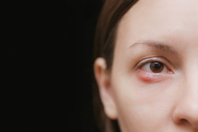 chalazion