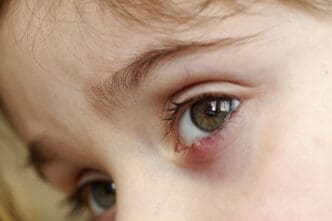 child with eye stye