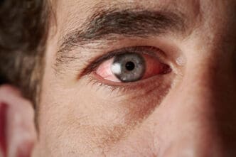 man with pink eye conjunctivitis