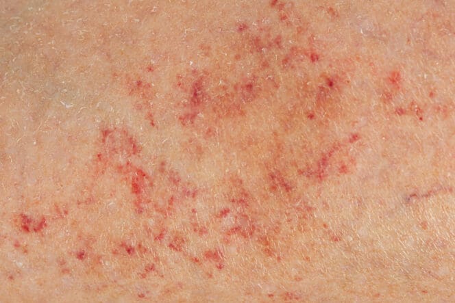 Petechiae Causes Treatment When to See a Doctor MyVision