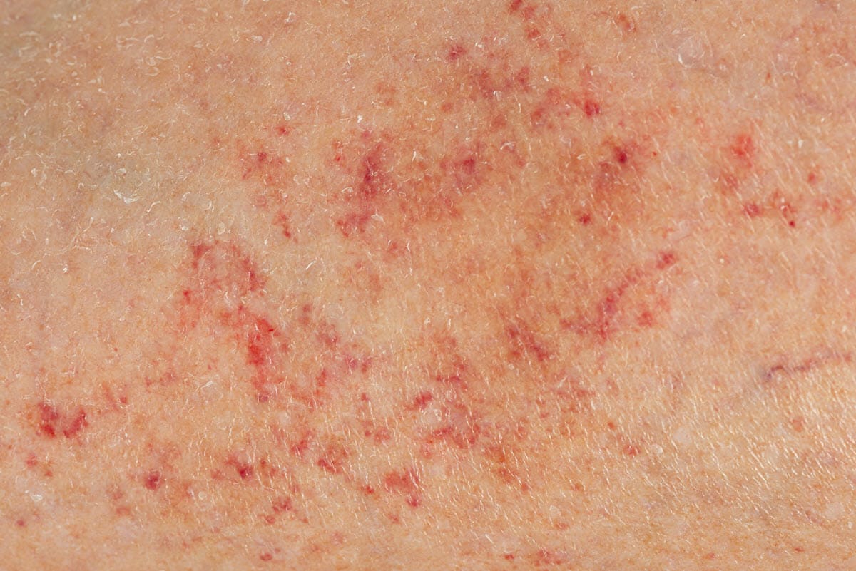 Red Spots on Skin: Causes, Treatments, and More