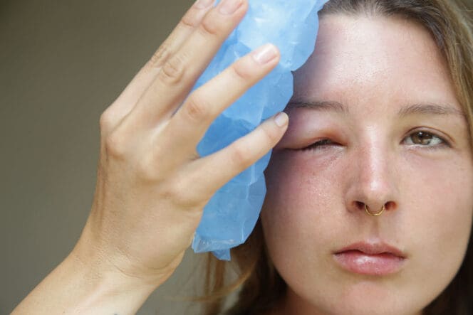 woman with swollen eyelid