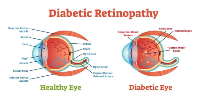 diabetic retinopathy diagram