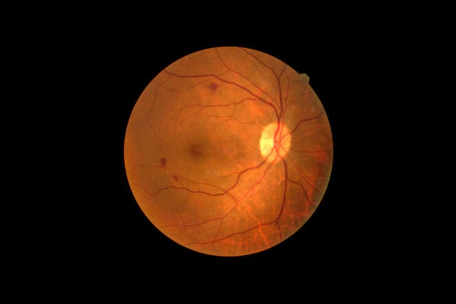 retinopathy