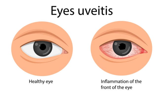 healthy eye vs uveitis