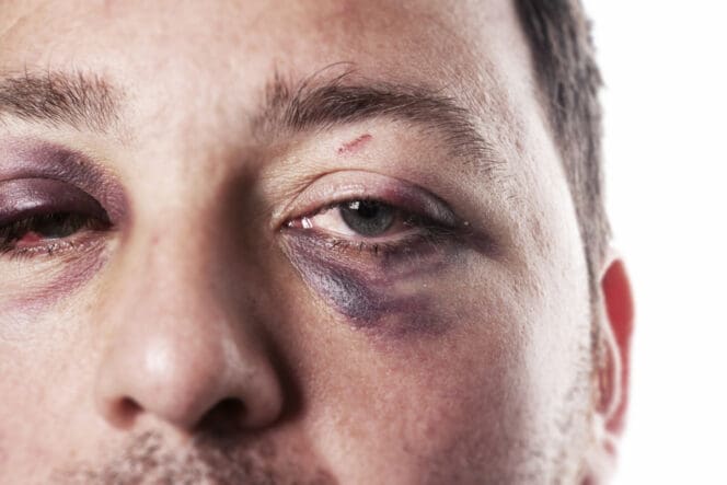 man with black eye