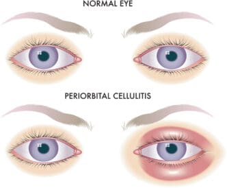 periorbital cellulitis