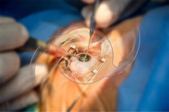 symfony intraocular lens