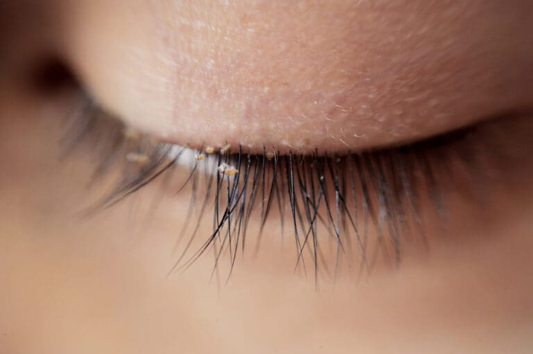 Eyelash Mites Signs Causes And Treatments 