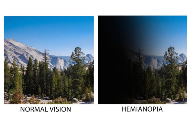 hemianopia vs normal vision