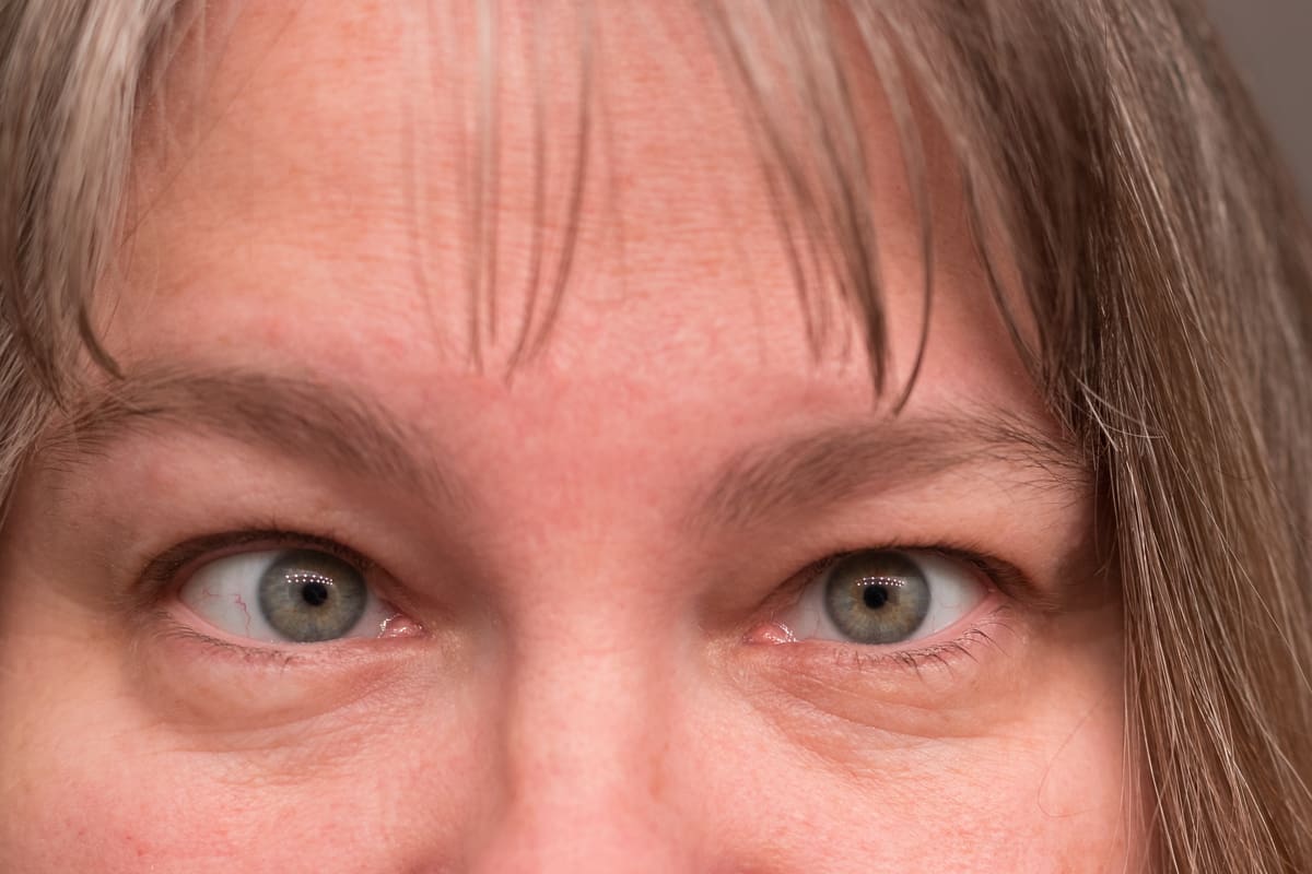 The aging eye: when to worry about eyelid problems - Harvard Health