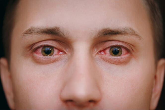 man with bloodshot eyes