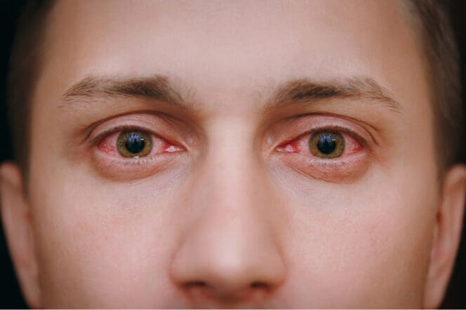 bloodshot-eyes-causes-symptoms-treatment-myvision