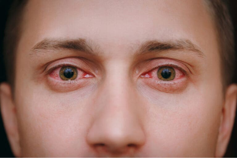 Bloodshot Eyes Causes, Symptoms & Treatment