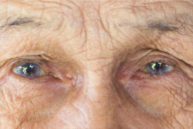 older man with cataracts