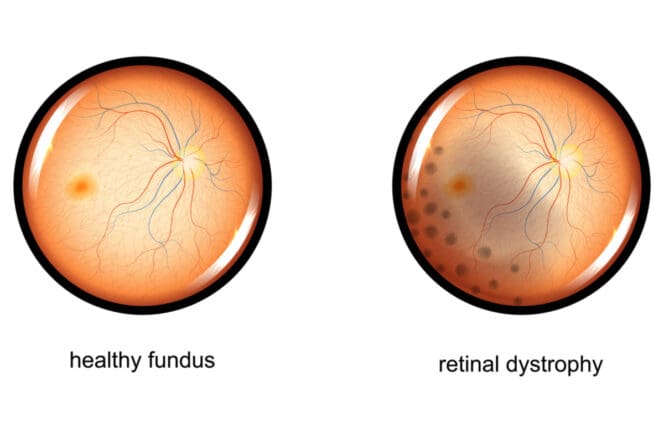 retinal dystrophy