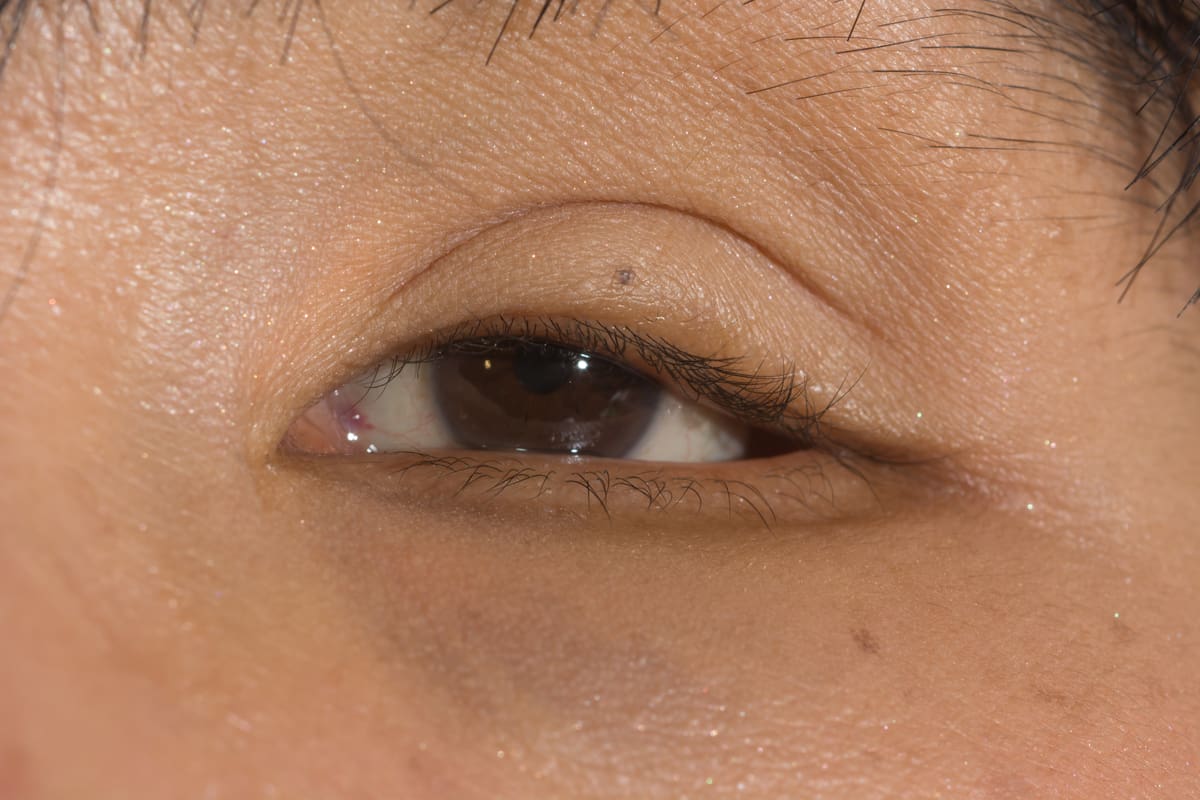 Non-Surgical Treatment for Thin Eyelid Skin, Hollowing, and Dark Under Eye  Circles 