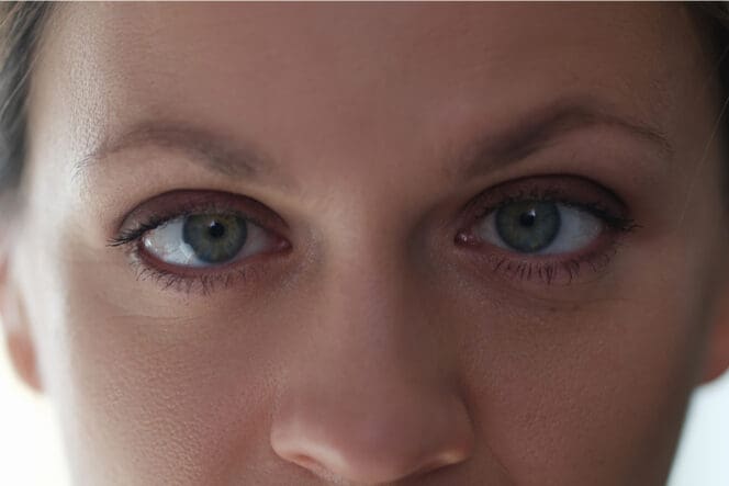 woman with lazy eye amblyopia