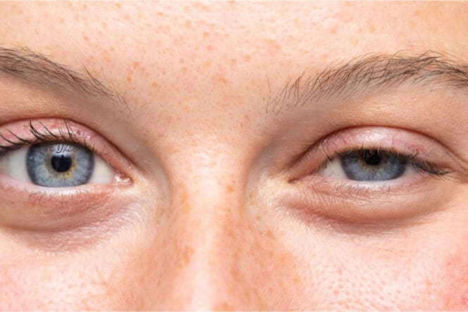 upper eyelid infection