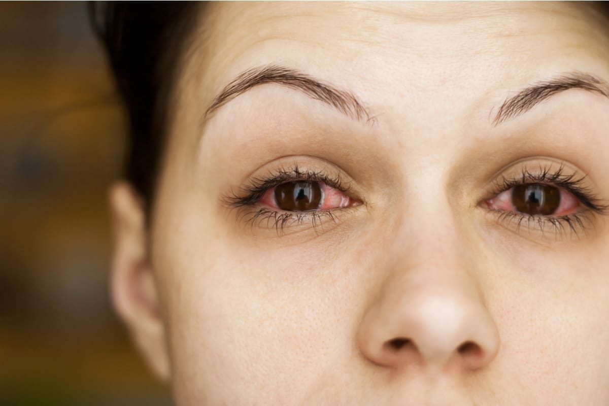 Red Eyes Causes Complications And How To Treat