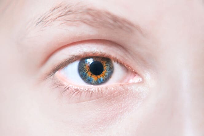 central heterochromia