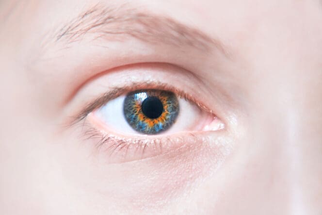 heterochromia brown blue