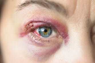 woman with eyelid cut laceration