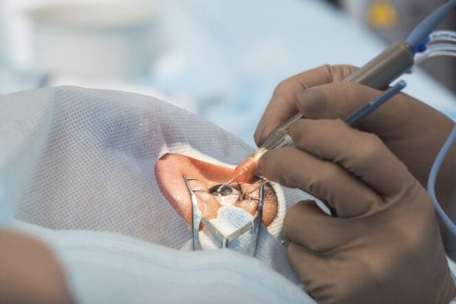 man undergoing trabeculectomy surgery