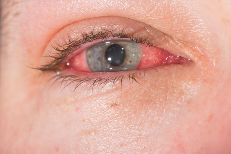 Scleritis: Causes, Symptoms, and Treatment | MyVision.org