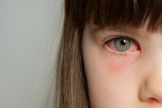young girl with pink eye