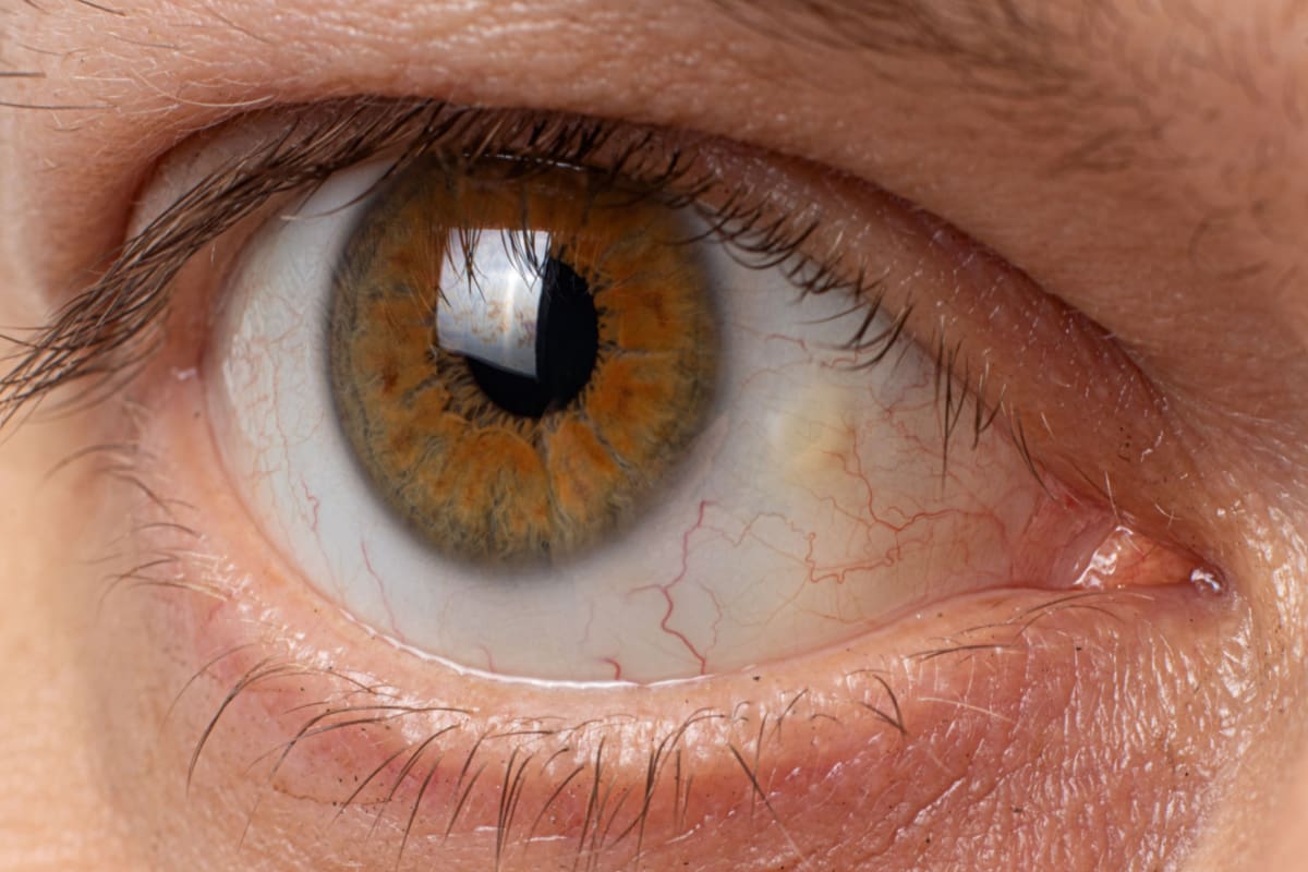 Yellow Eyes: Causes and Treatments