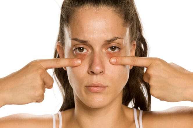Tired of Under Eye Bags Making You Look Tired Learn Your Remedy Options  Radiance Wellness MediSpa Medical Aesthetics Specialists