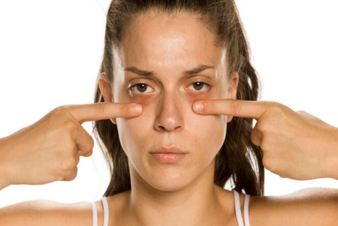 Bags Under Eyes: Causes & How to Get Rid of Them