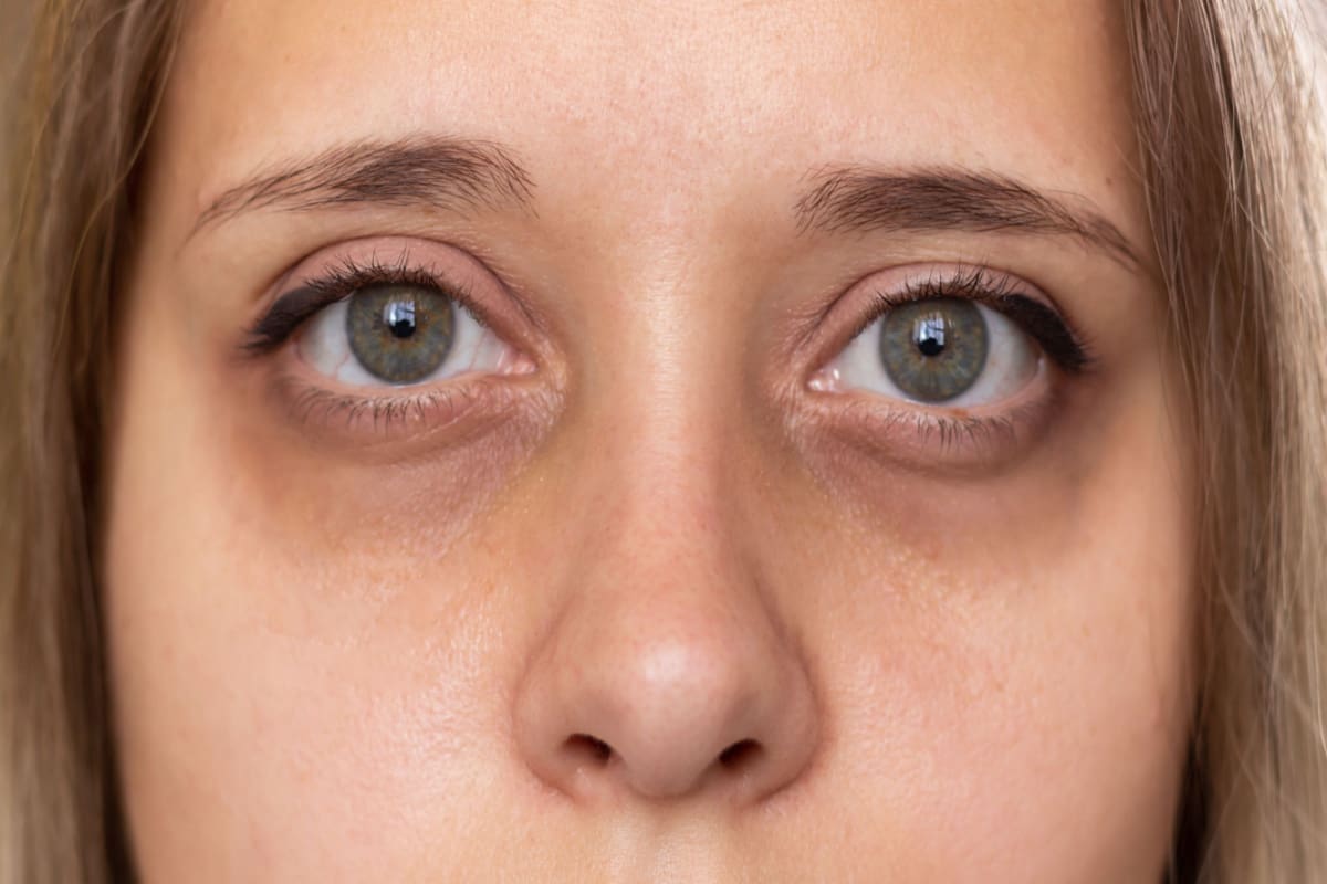 Lower eye bags: Too little or too much fat?
