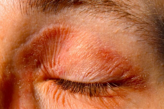 eyelid eczema