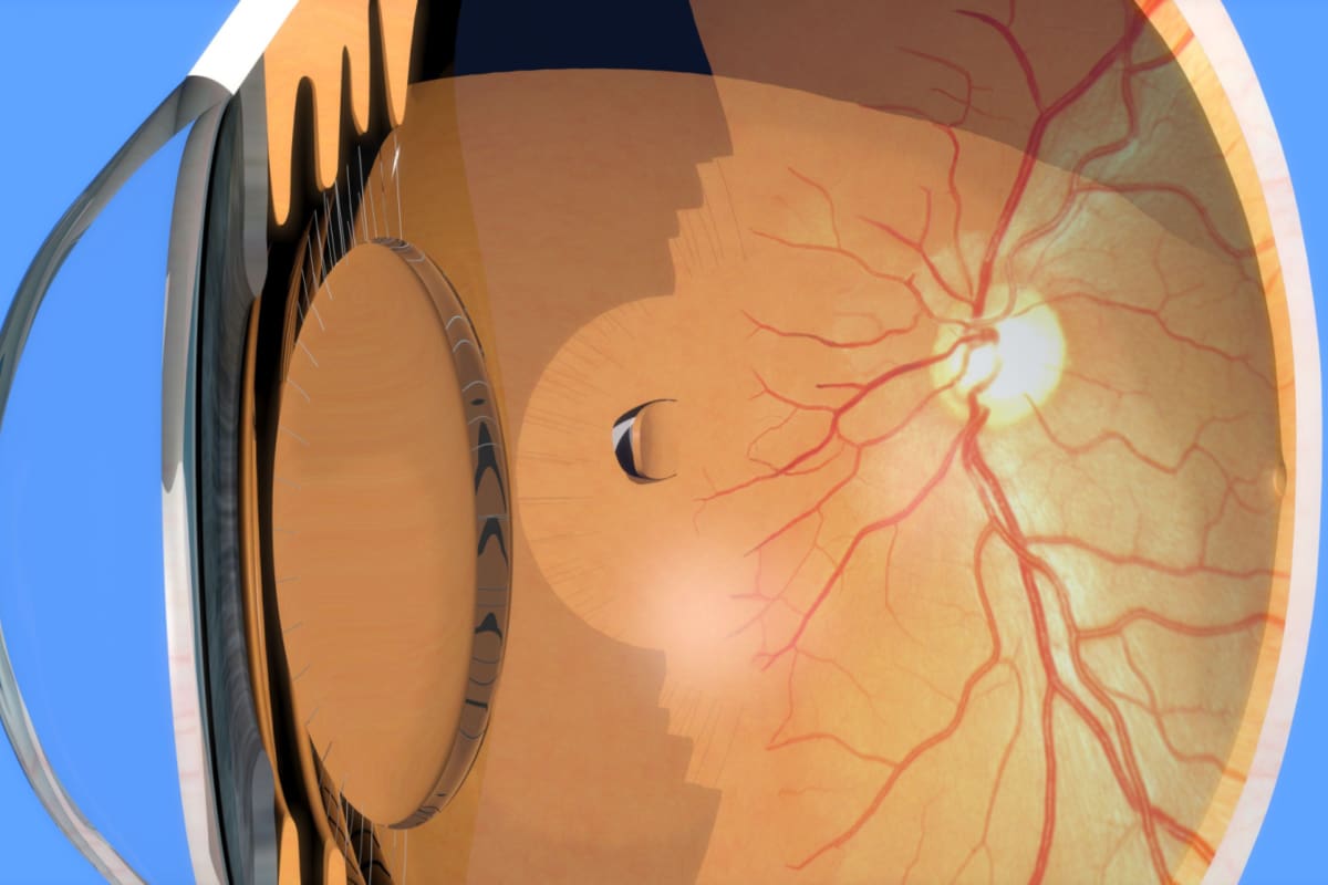 Retina Issues: What are the Symptoms?