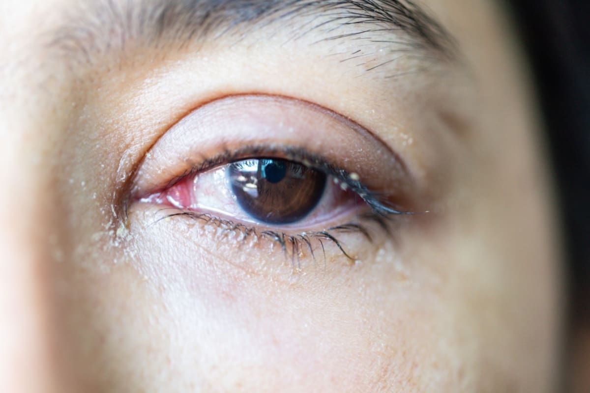 Watery Eyes (Epiphora) Causes & Treatment