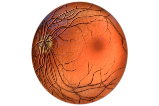 optic nerve cupping