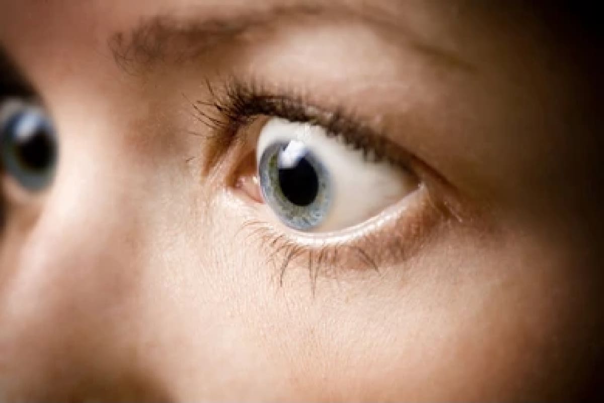 Bulging Eyes Exophthalmos Or Proptosis Causes Treatment MyVision