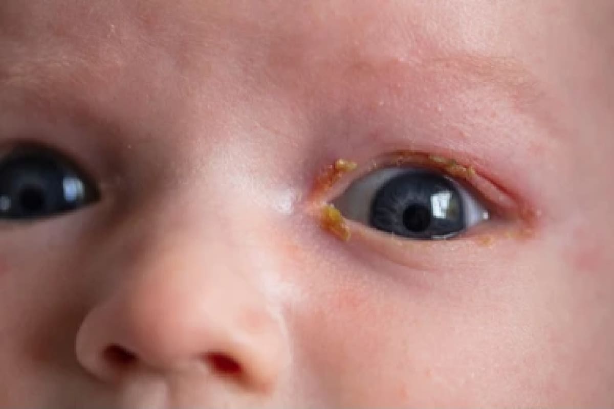 Eye Boogers: Types, Causes & How to Get Rid of Them