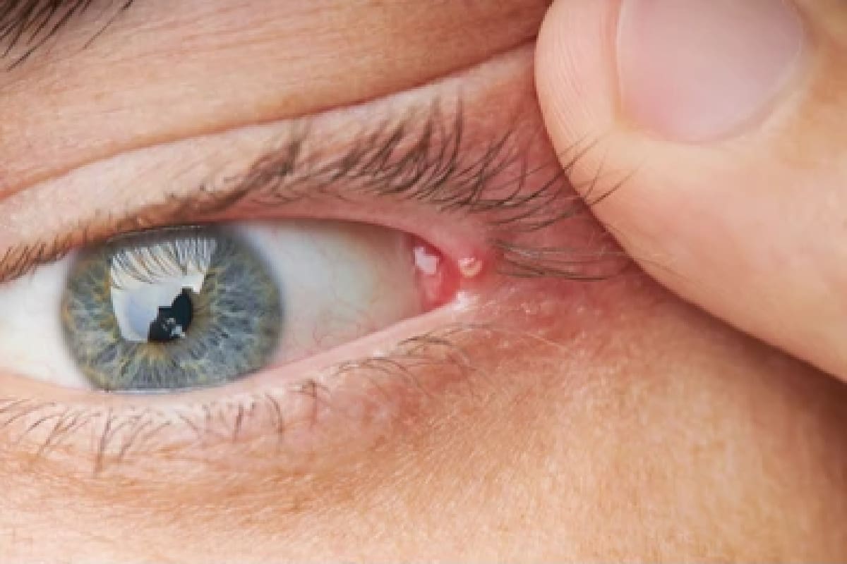 Eyelid Pimple Inside   How To Get Rid Of A Pimple Or Bump On The Eyelid 