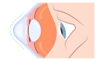 corneal ectasia