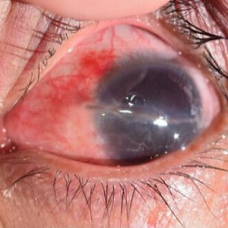 corneal laceration