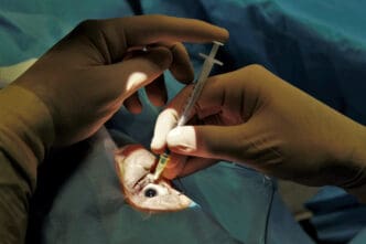 anesthesia during cataract surgery what you need to know