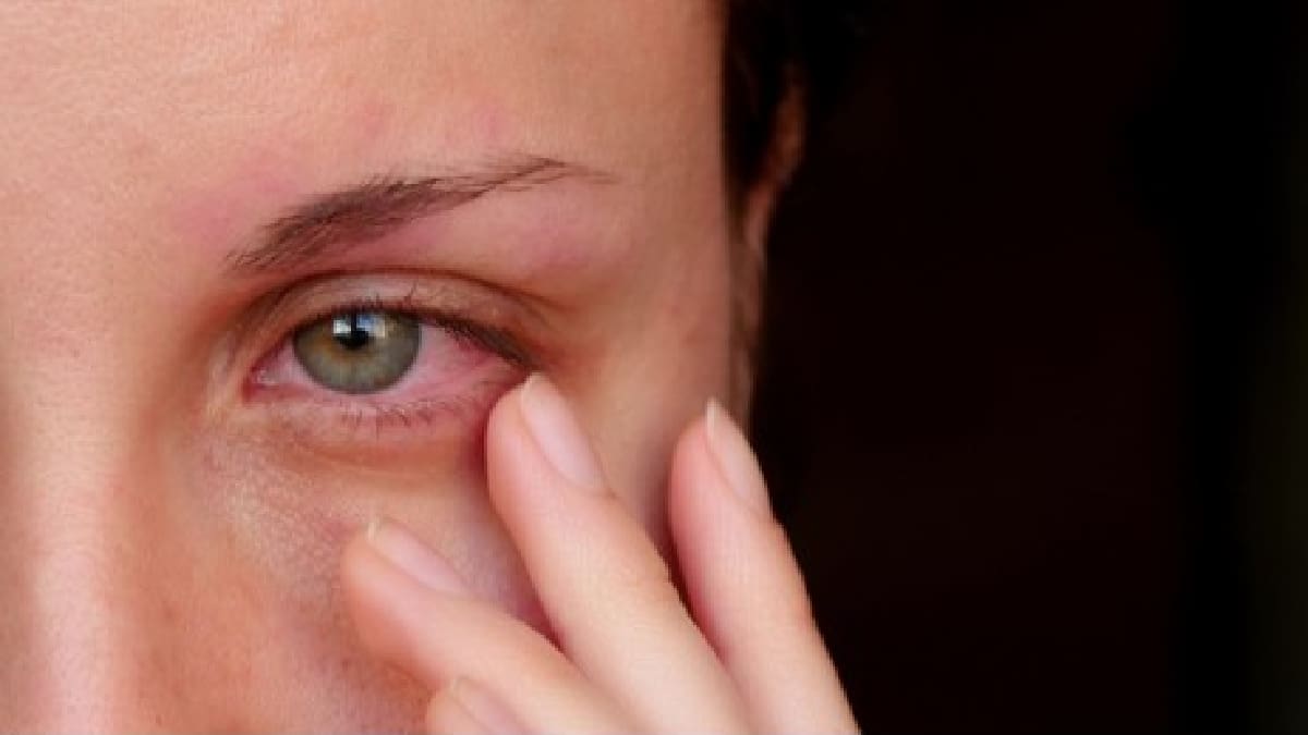 How To Soothe Irritated Skin Around Eyes