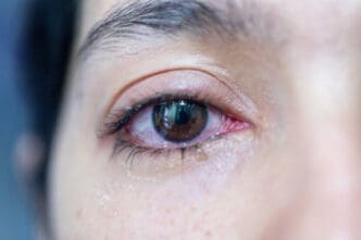 meibomian gland dysfunction signs causes treatment