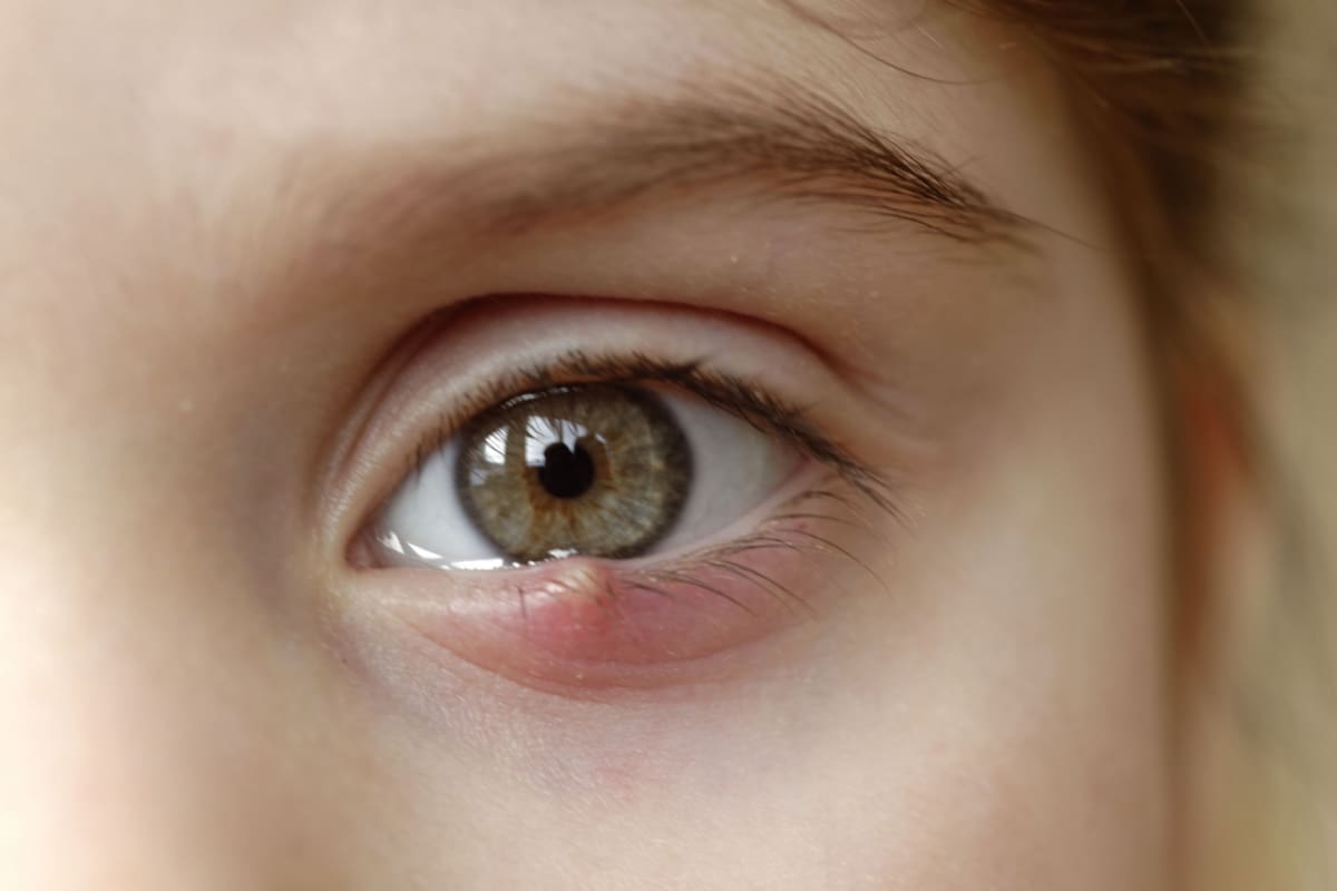 Chalazion Vs Stye What Are The Differences Between The Two